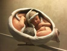 Ceramic twins in uterus
